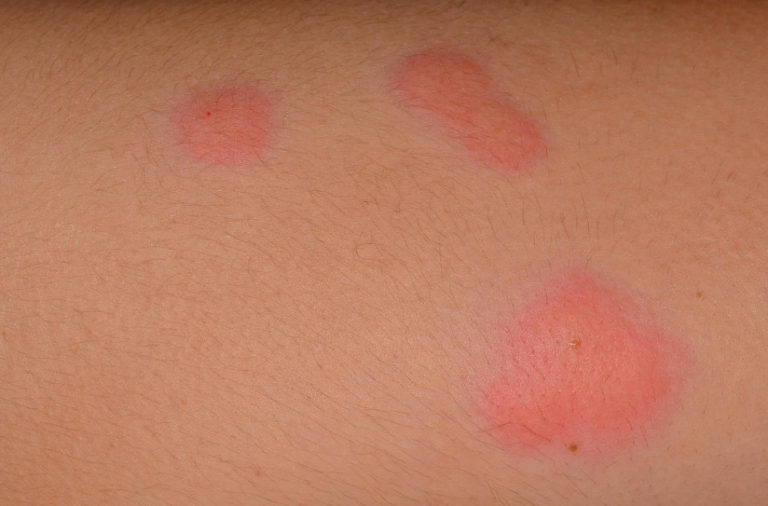 Allergy to Insect Bites What is Dangerous and How to Help the Victim