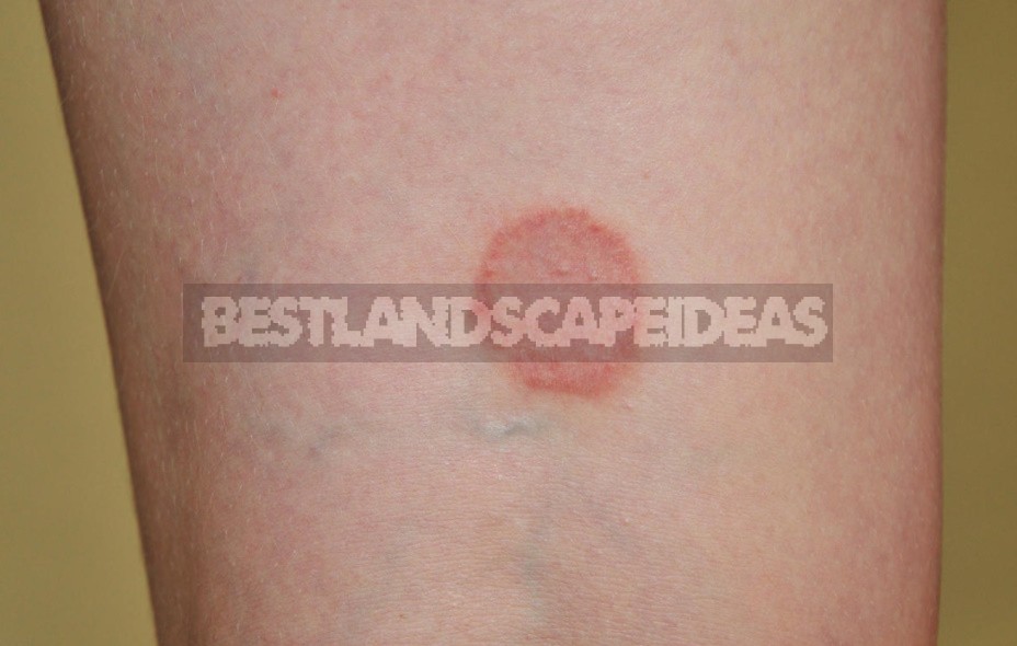 Ringworm: What Is The Danger Of This Disease?